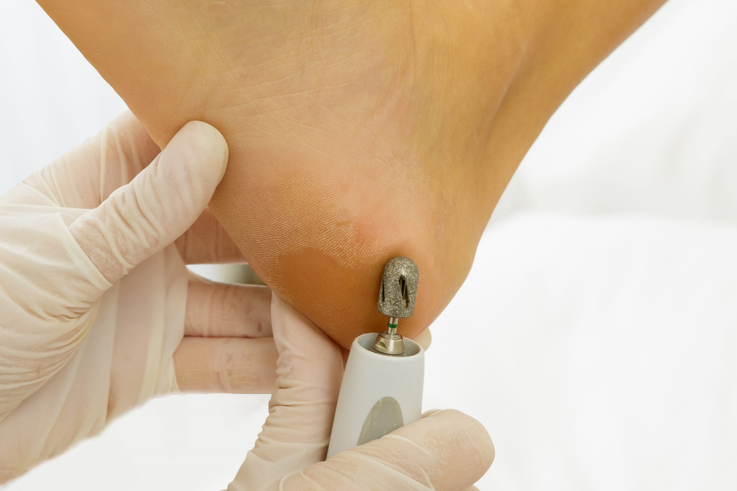 opracowywanie-piety-z-modzelem-na-stopie