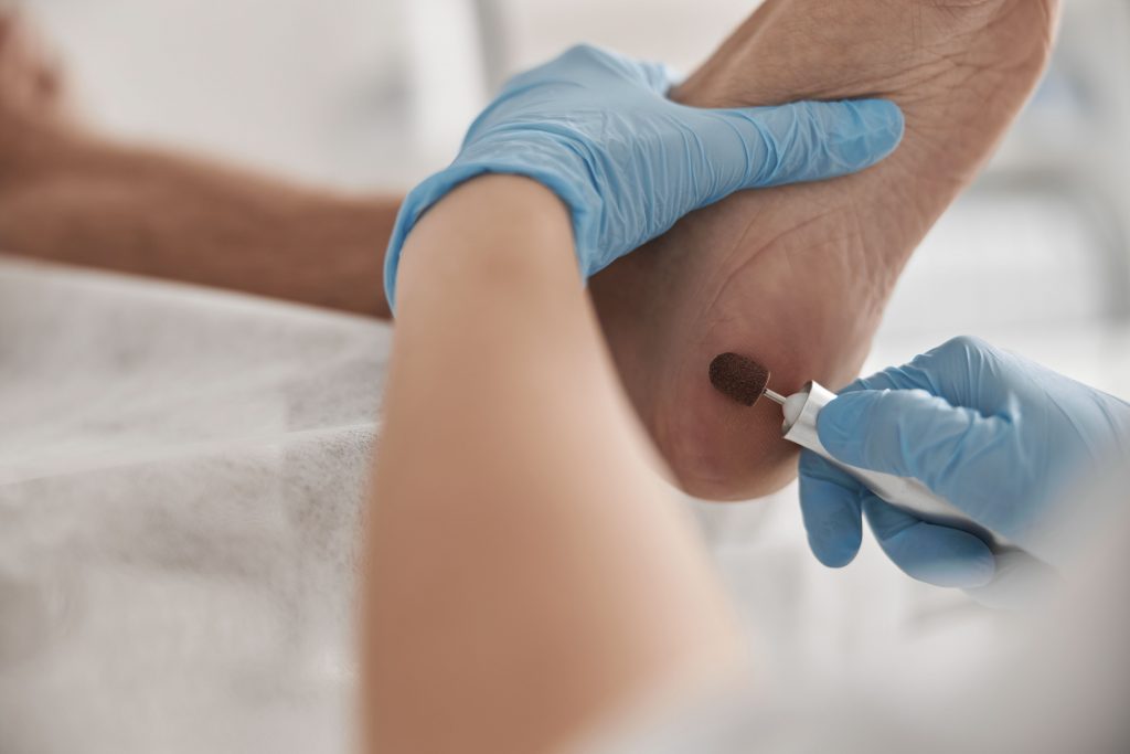 zabieg-podologiczny-u-podologa-usuwanie-modzeli